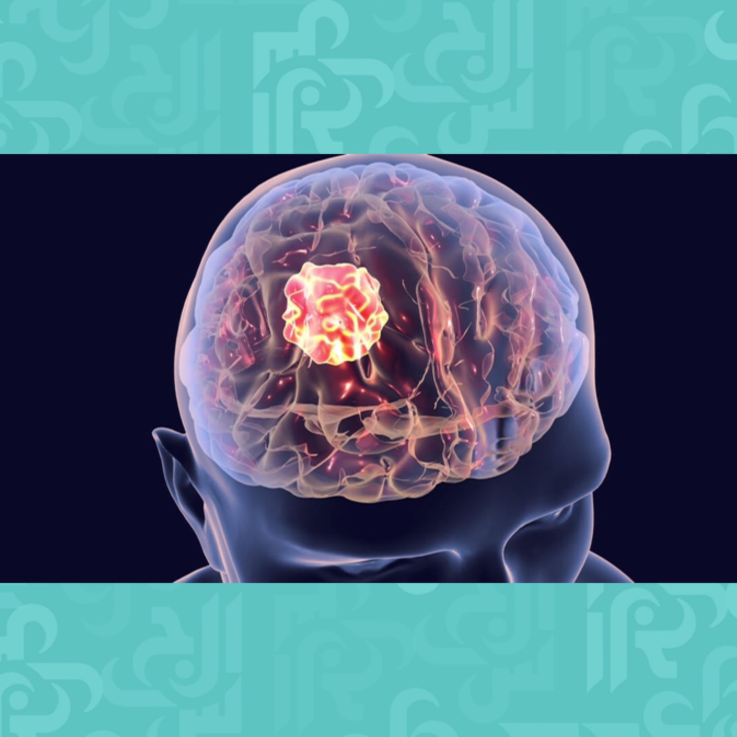 أسباب وأعراض ورم الدماغ | مجلة الجرس