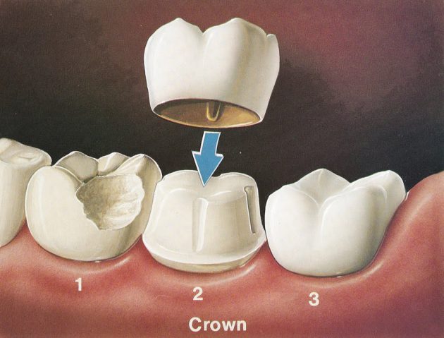 تلبيس الأسنان يؤدي إلى فقدانخها