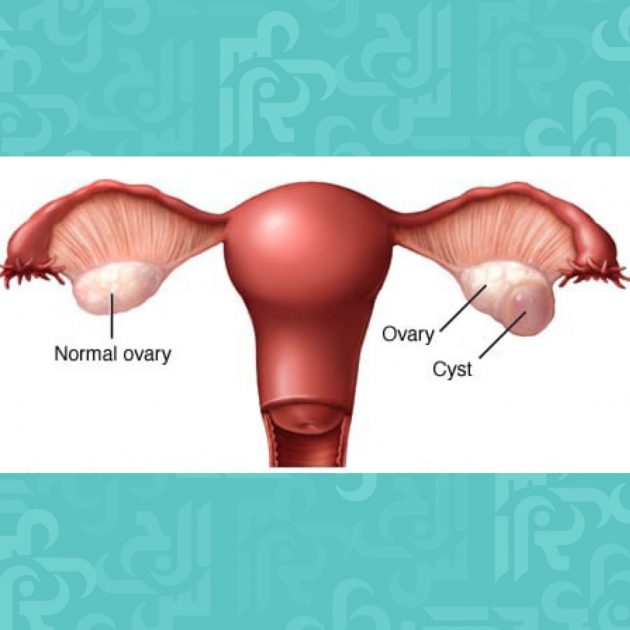 أسباب وأعراض ظهور الأكياس على المبيض