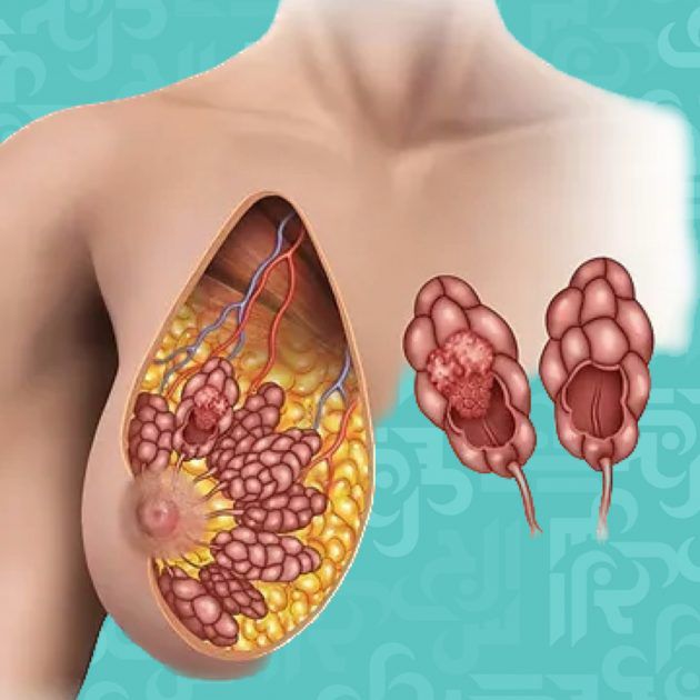 أسباب وأعراض تكتل أنسجة الثدي