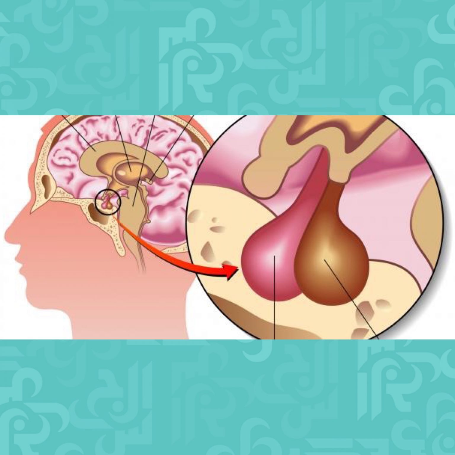 أسباب وأعراض قصور الغدة النخامية