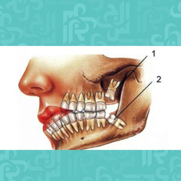 أسباب وأعراض ضروس العقل المتأثرة