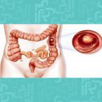 أسباب وأعراض متلازمة الأمعاء القصيرة