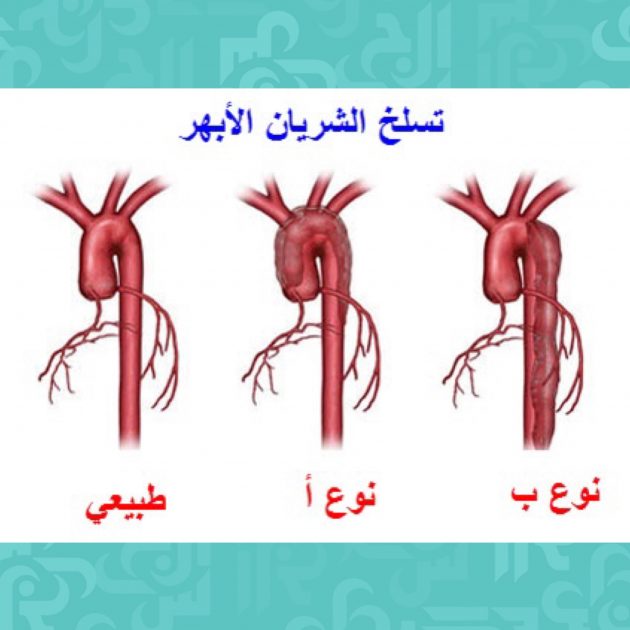 أسباب وأعراض تسلخ الشريان الأبهر