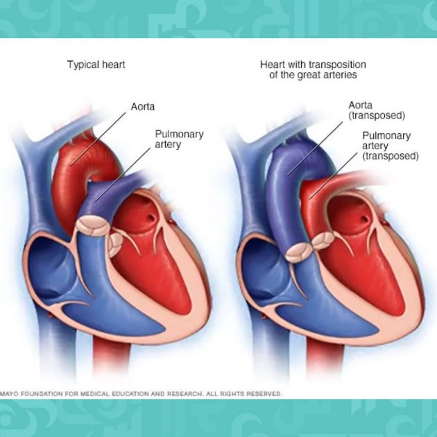 أسباب وأعراض تحويل الشرايين الكبيرة