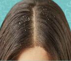 وصفات طبيعية للتخلص من قشرة الشعر!
