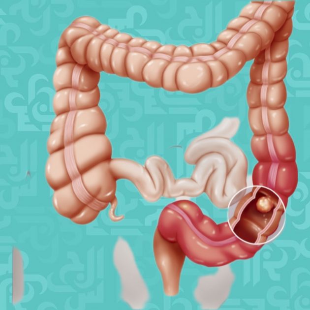 أعراض تحذيرية لسرطان القولون للشباب والشابات دون الخمسين!