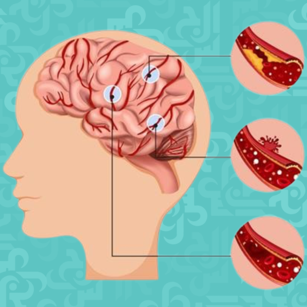 عدد الاصابات بالسكتة الدماغية سنويًا - دراسة