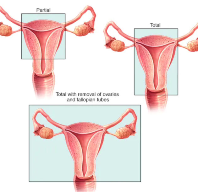 لماذا يُستأصل الرحم؟ - دراسة